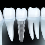 IMPLANTS