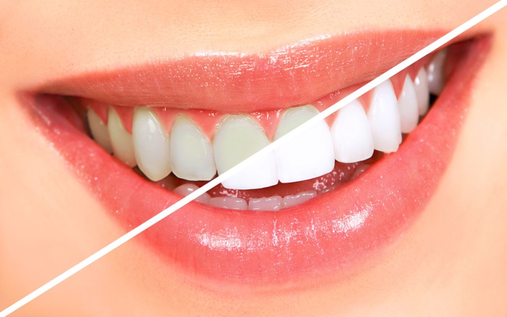 Dental Whitening (Serving Ogden)