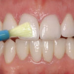 FLUORIDE TREATMENT