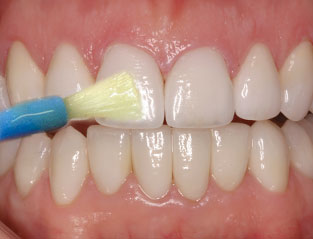 Is Fluoride Bad For You? fluoride