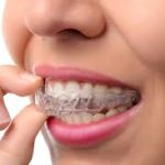 CLEAR BRACES