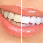 TEETH WHITENING
