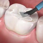 SEALANTS