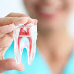 ROOT CANAL