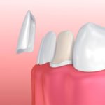 VENEERS