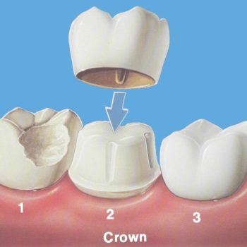 North View Dental Crowns North Ogden Utah