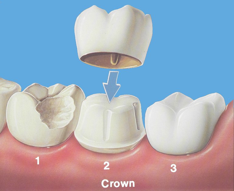 Dental Crowns (When Are They Needed)