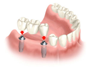 Tooth Implants Example