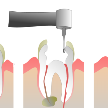 North View Dental Root Canal North Ogden Utah