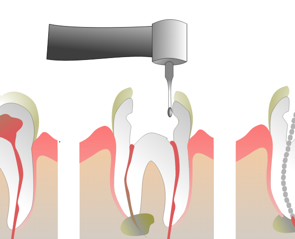 North View Dental Root Canal North Ogden Utah