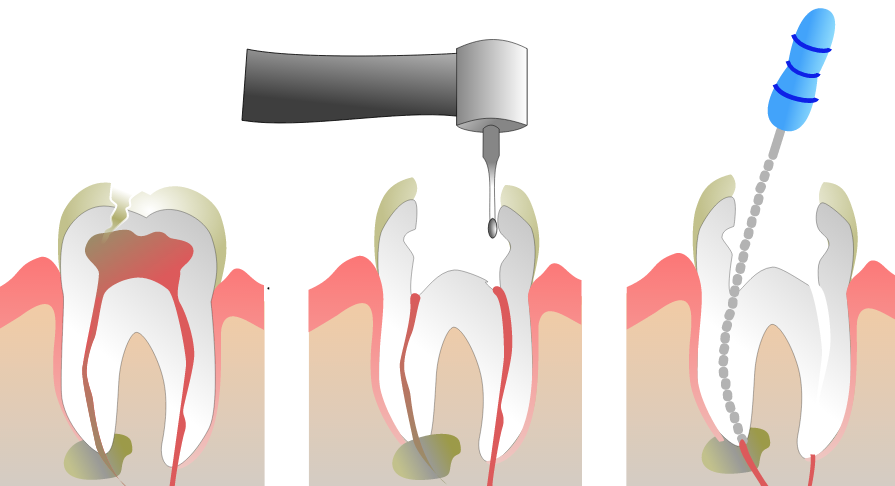 Root Canal Procedure