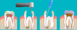 Root Canal Procedure root-canal-therapy