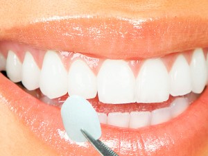 Do Veneers Damage Your Teeth?