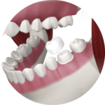 CROWNS