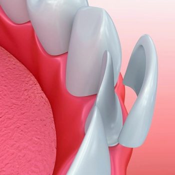 North View Dental Veneers North Ogden Utah