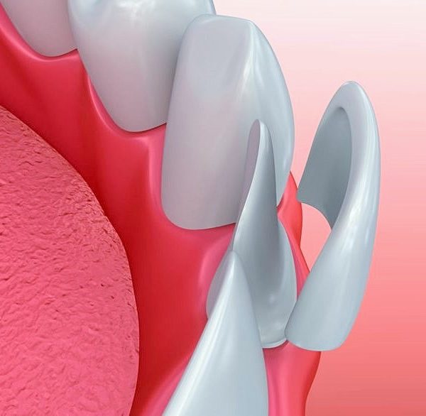 North View Dental Veneers North Ogden Utah