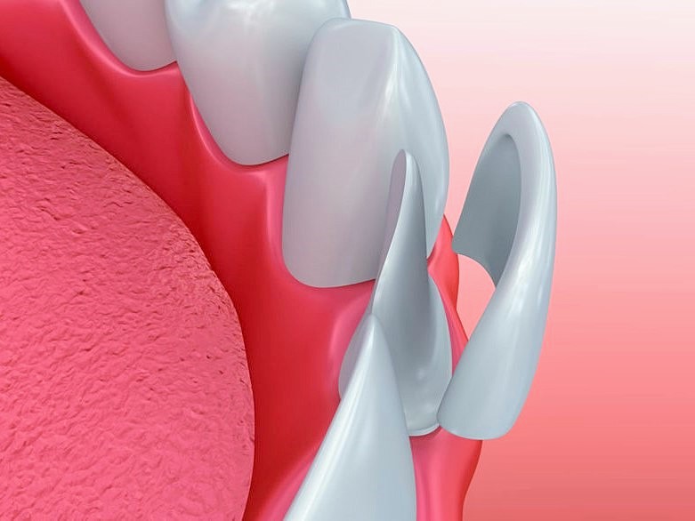 Do i need veneers? North View Dental Utah