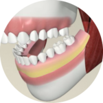 DENTURES