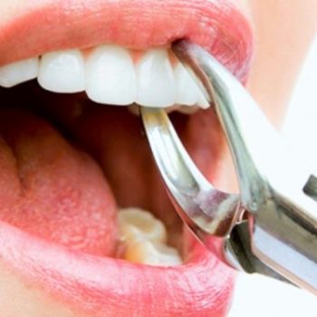 North View Dental Tooth Extraction North Ogden Utah