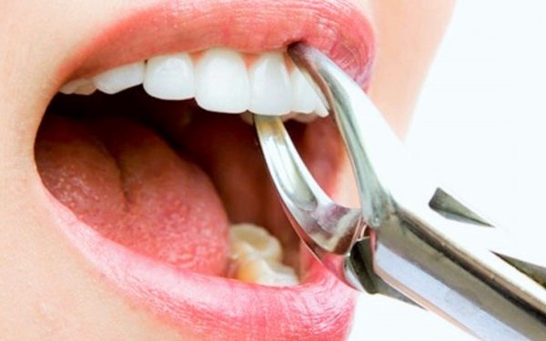 North View Dental Tooth Extraction North Ogden Utah