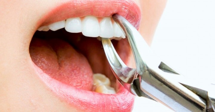 Tooth Extraction Aftercare (Healing Tips)
