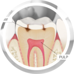 FILLINGS