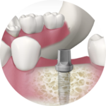 IMPLANTS