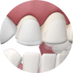 VENEERS