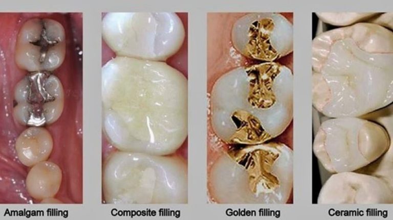 Dental Filling Procedure dental filling types of fillings