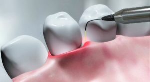 Laser Dentistry (No Drill Dentistry) laser dentistry closeup