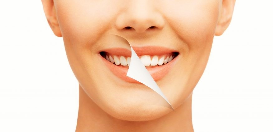 How a Smile Makeover Boosts Confidence