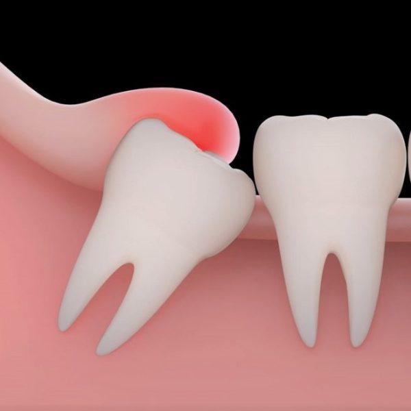 North View Dental Wisdom Teeth North Ogden Utah