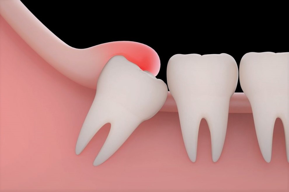 Do I Really Need To Have My Wisdom Teeth Removed?
