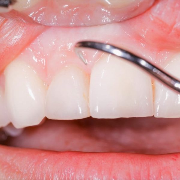 North View Dental Gingivitis North Ogden Utah