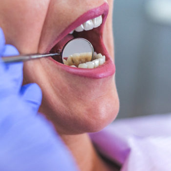 North View Dental Tooth Infection North Ogden Utah