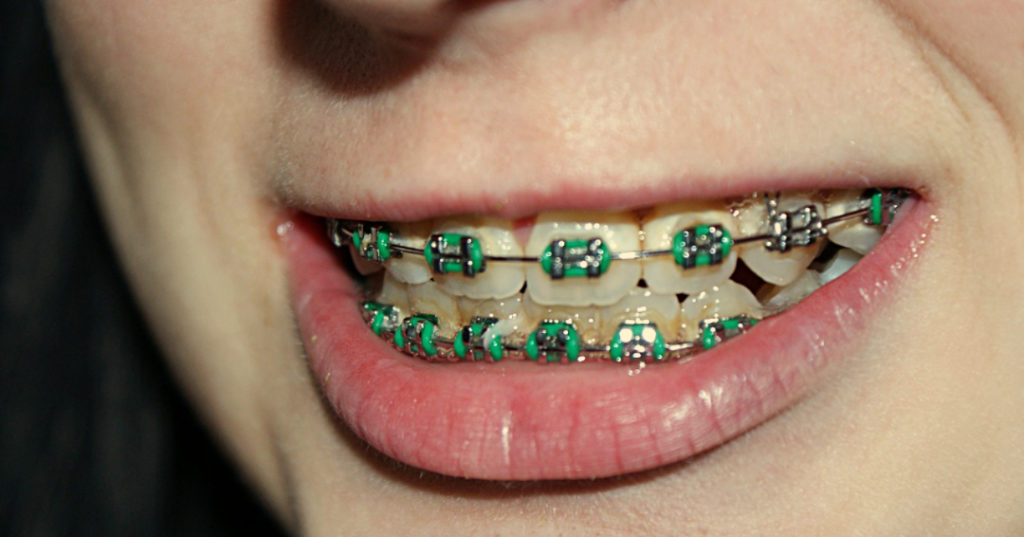 Why are Braces Important?