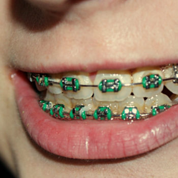 North View Dental braces North Ogden Utah