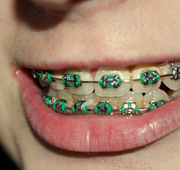 North View Dental braces North Ogden Utah