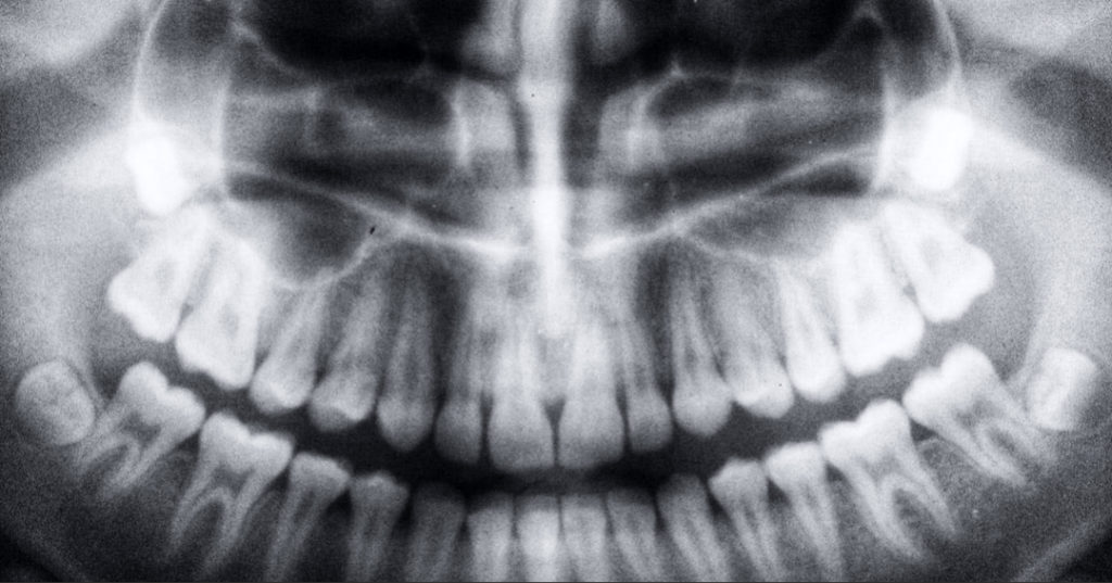 Why are Dental Tooth X-Rays Needed? North View Dental Utah