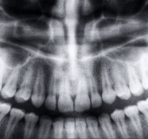 North View Dental Tooth X-Rays North Ogden Utah