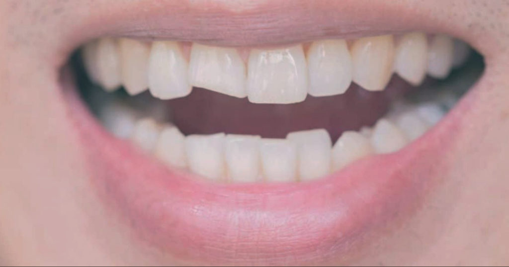 Can a Broken Tooth Be Fixed?