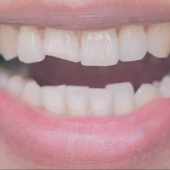 North View Dental Broken Tooth North Ogden Utah