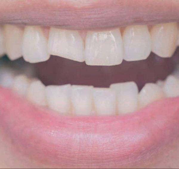 North View Dental Broken Tooth North Ogden Utah