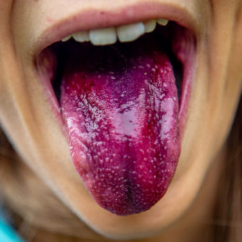 North View Dental Tongue North Ogden Utah