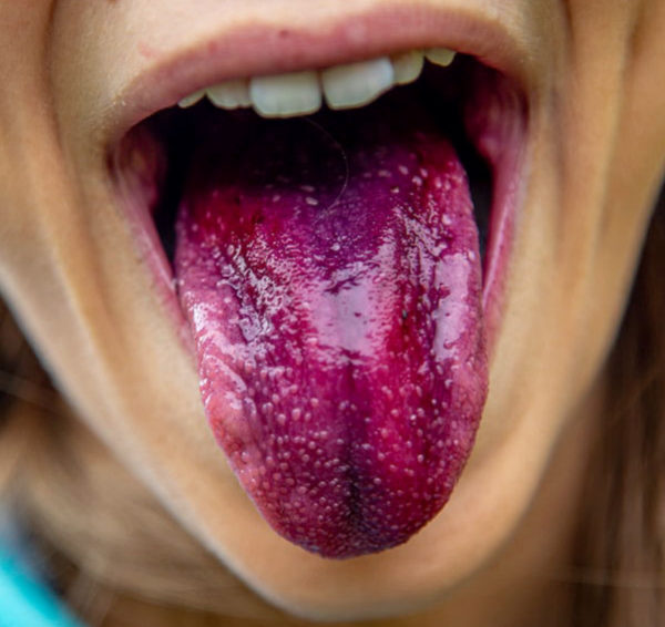 North View Dental Tongue North Ogden Utah