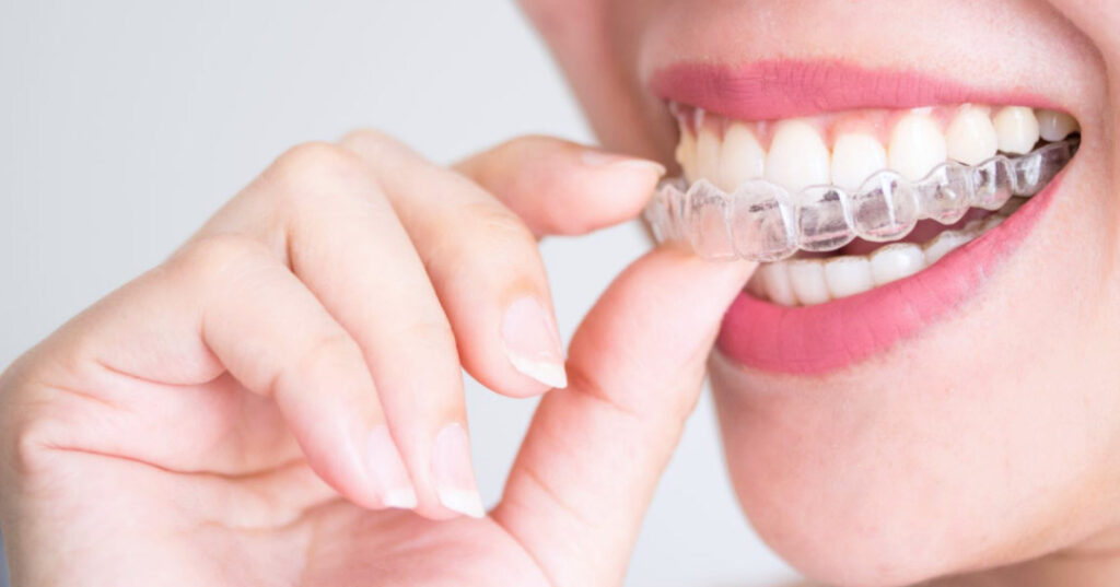 Is Wearing Invisalign Right For You?
