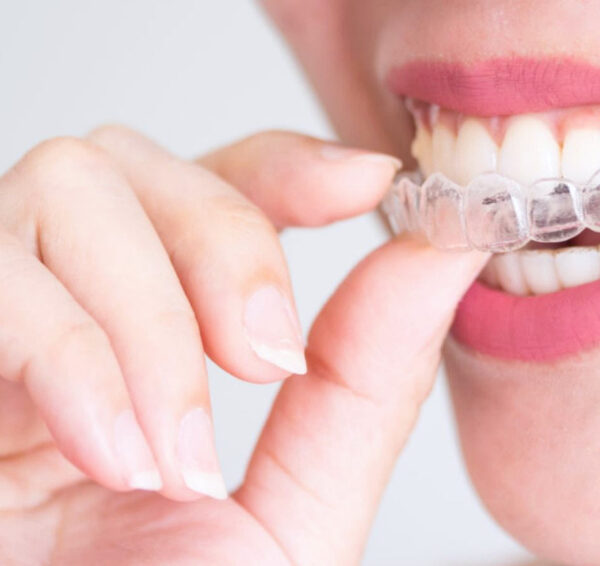 North View Dental Invisalign North Ogden Utah