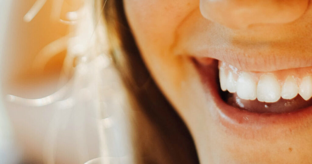Your Options for Whitening Teeth