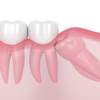 6 Things To Avoid After Wisdom Teeth Removal wisdom teeth removal