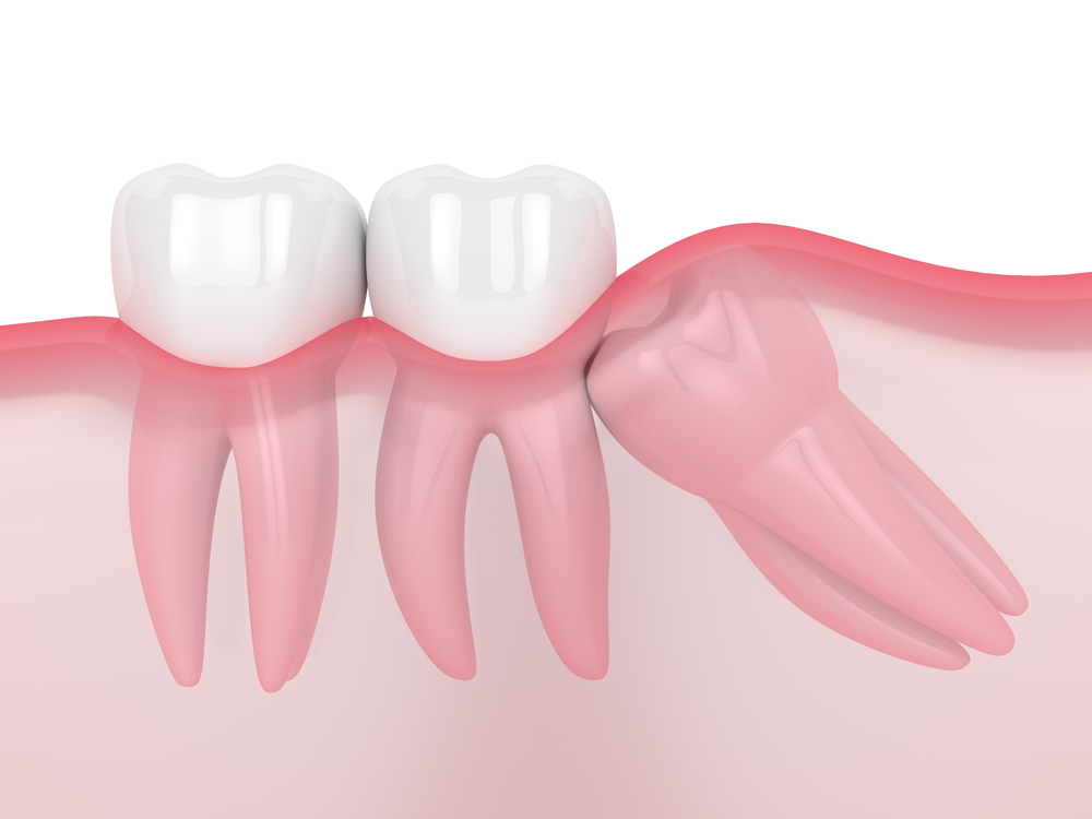 wisdom teeth removed